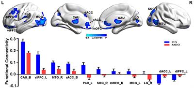 Mediating Role of the Reward Network in the Relationship between the Dopamine Multilocus Genetic Profile and Depression